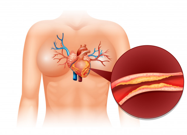 How to lower triglycerides?